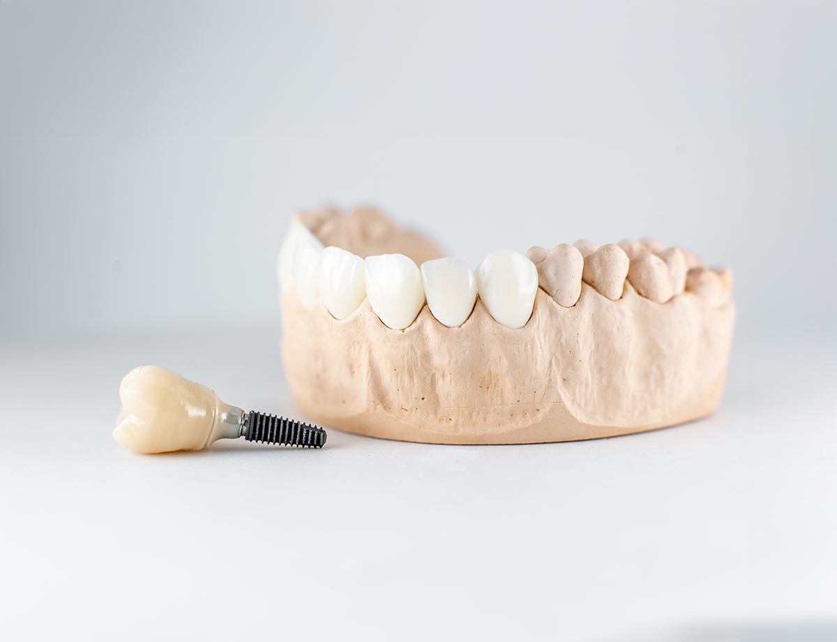 paslauga_Klinika-Šypsena-dantų-implantacija