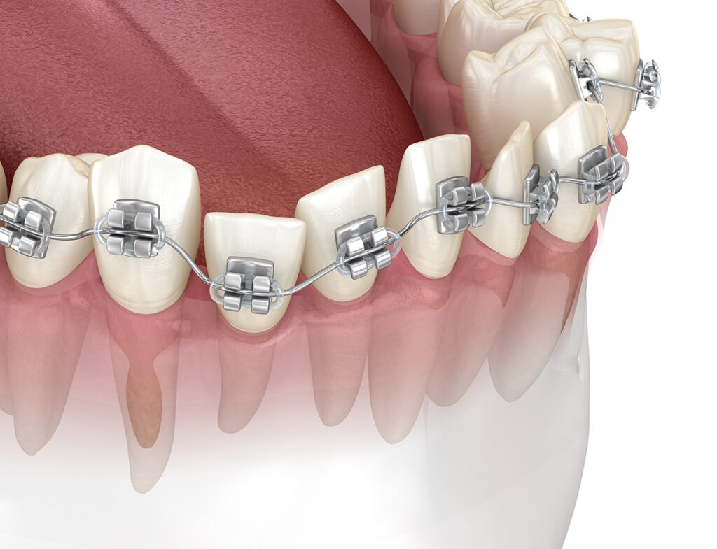 Klinika Sypsena kada reikalingas ortodontinis gydymas