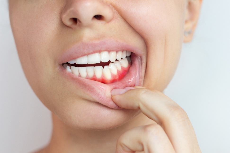 sypsenaok klinika periodontologija 1