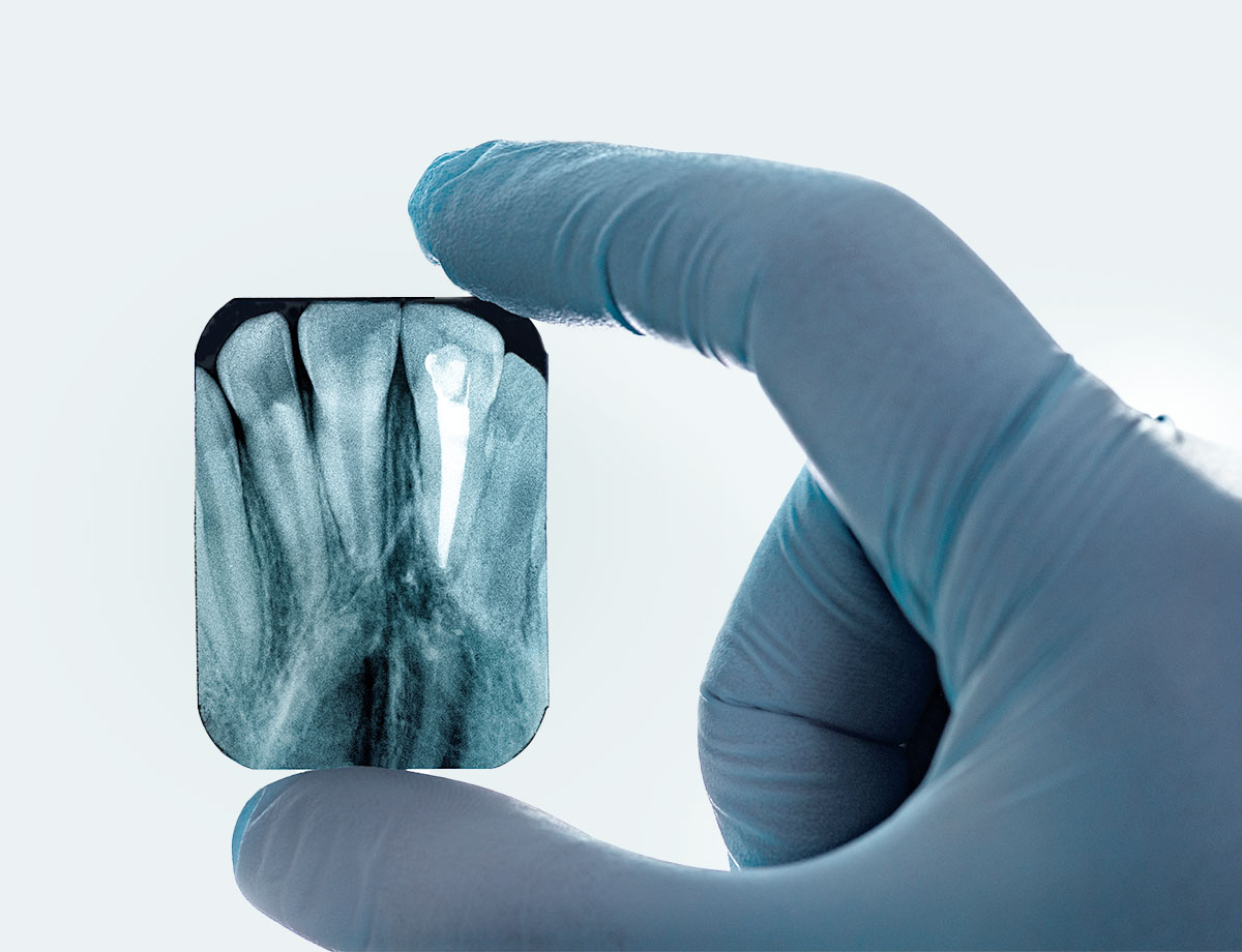 paslauga Klinika Sypsena dantu kanalu gydymas endodontija