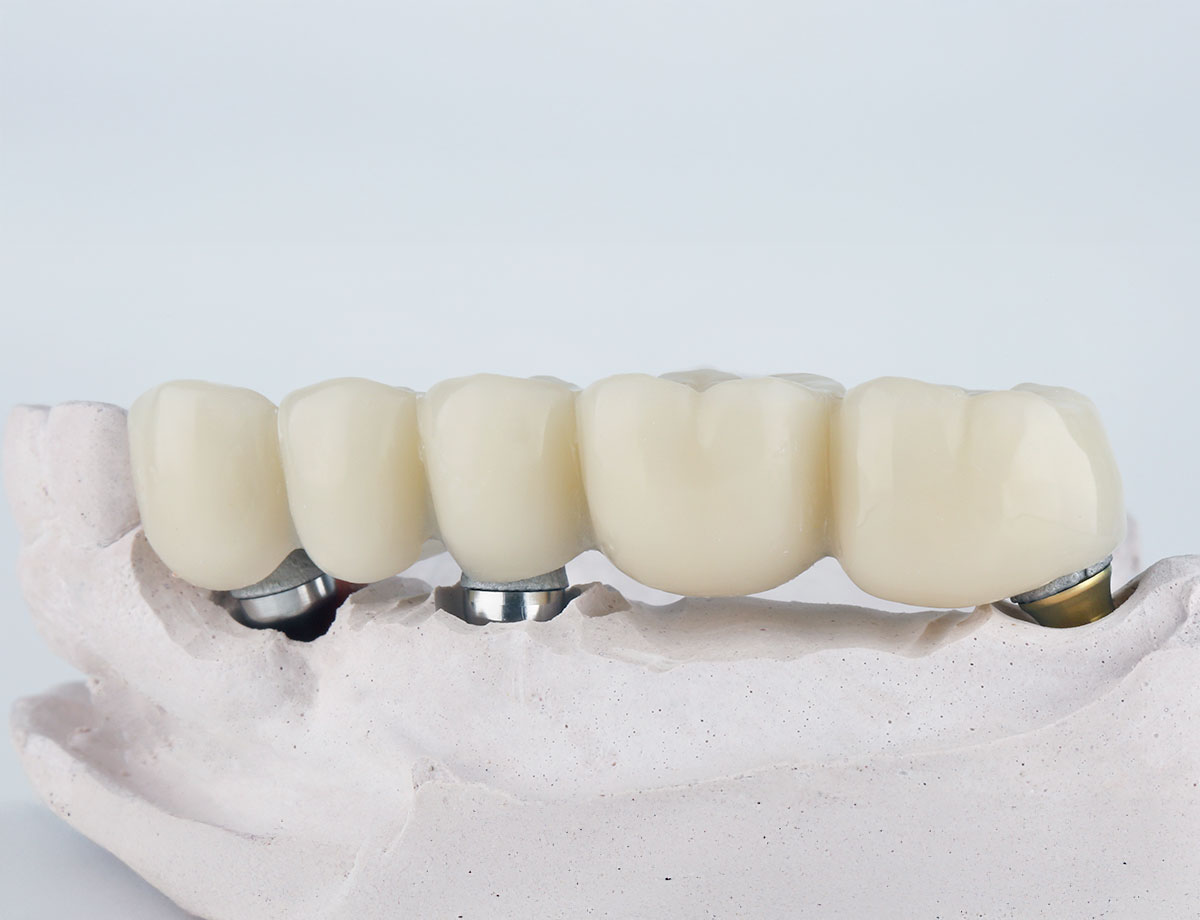 paslauga Klinika Sypsena protezavimas vainikeliai tiltiniai protezai karuneles