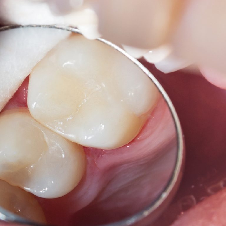 klinika_sypsena_terapinis_dantu_plombavimas_eduonies_gydymas