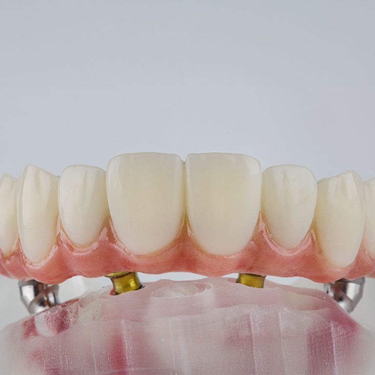 paslauga_Klinika-Sypsena-all-on-4