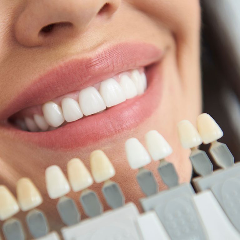 paslauga_Klinika-Sypsena-dantu-balinimas