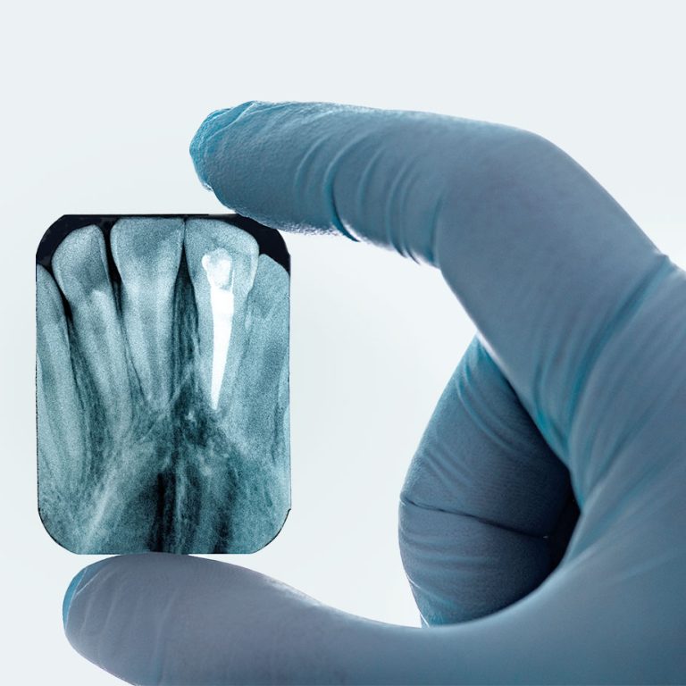 paslauga_Klinika-Sypsena-dantu-kanalu-gydymas_endodontija__