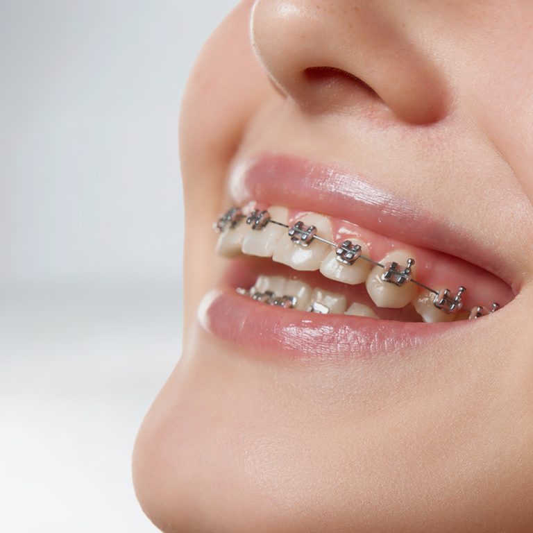 paslauga_Klinika-Sypsena-dantu-tiesinimas-ortodontinis-gydymas-breketai