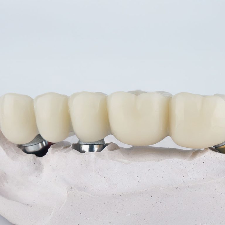 paslauga_Klinika-Sypsena-protezavimas-vainikeliai-tiltiniai-protezai-karuneles